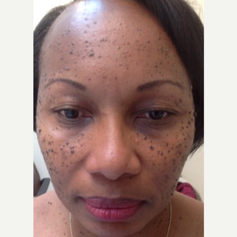 45-54 year old woman treated with Mole Removal before 3459311