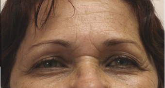 60 year old female status post in Office Setting Bilateral Brow Lift. before 925603