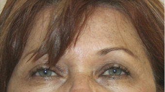 60 year old female status post in Office Setting Bilateral Brow Lift. after 925603