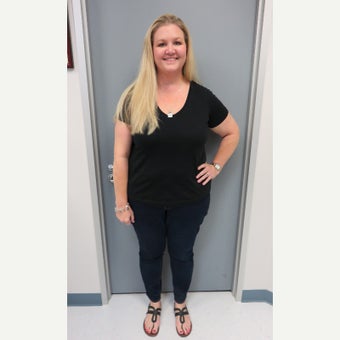 35-44 year old woman treated with Sleeve Gastrectomy after 2562357