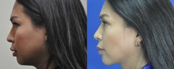 36 year old female treated for weak chin, double chin, and excess buccal fat before 999521