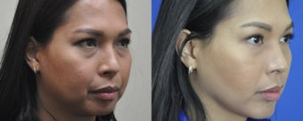 36 year old female treated for weak chin, double chin, and excess buccal fat 999521