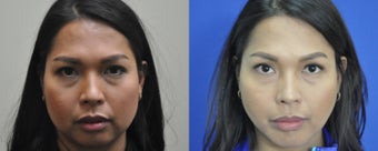 36 year old female treated for weak chin, double chin, and excess buccal fat after 999521