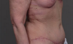 55-64 year old woman treated with Tummy Tuck after 3282402