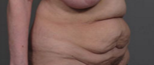 55-64 year old woman treated with Tummy Tuck before 3282402