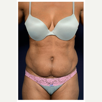 45-54 year old woman treated with Tummy Tuck before 3076169