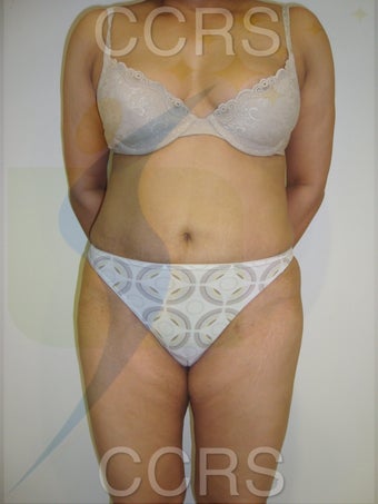 VASER lipo with Mini TT, 35 yrs. old female after 636139