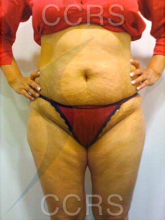 VASER lipo with Mini TT, 35 yrs. old female before 636139