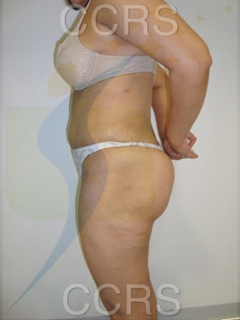 VASER lipo with Mini TT, 35 yrs. old female 636139
