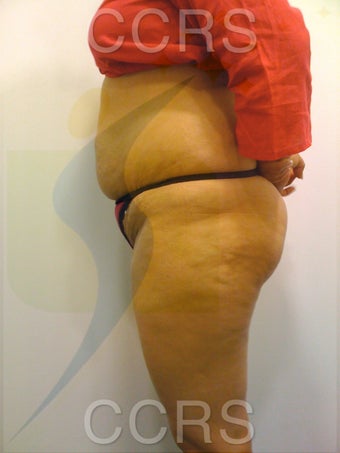 VASER lipo with Mini TT, 35 yrs. old female 636139