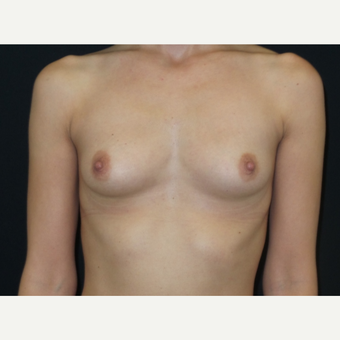 25-34 year old woman treated with Breast Implants before 3650892