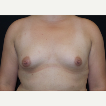 25-34 year old woman treated with Breast Augmentation before 3182005