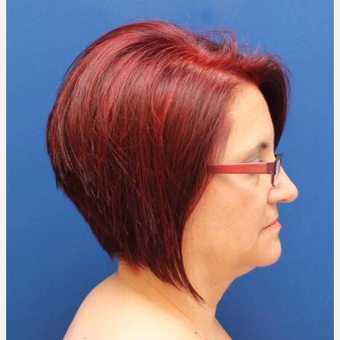 57 year old female, SMAS plication facelift before 3814724