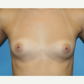 22 year old woman treated with Breast Augmentation before 3486724