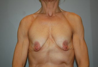 51 year old woman treated with Breast Lift with Implants before 2234891