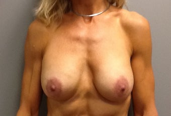 51 year old woman treated with Breast Lift with Implants after 2234891