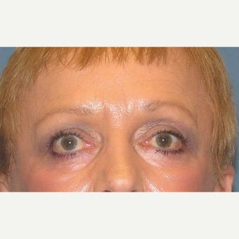 Quicklift w/neck liposuction after 1850932