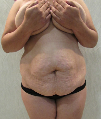 35-44 year old woman treated with Tummy Tuck before 2088728