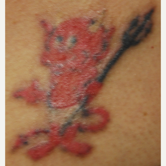 42 year old Woman Treated with PicoSure 532nm Laser for Tattoo Removal before 3137806