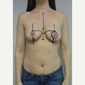 25-34 year old woman treated with Breast Lift with Implants before 3481814