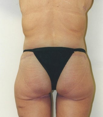 45-54 year old woman treated with Body Lift after 1809227