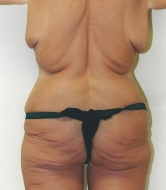 45-54 year old woman treated with Body Lift before 1809227