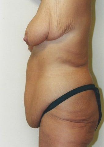 45-54 year old woman treated with Body Lift 1809227