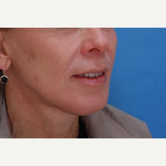 45-54 year old woman treated with Lip Lift, Skin Resurfacing and Facelift after 1810145