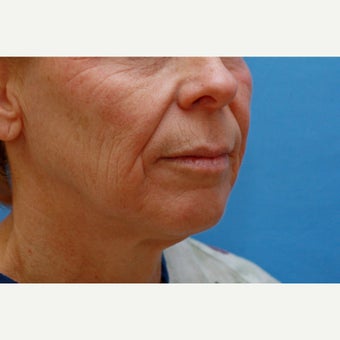 45-54 year old woman treated with Lip Lift, Skin Resurfacing and Facelift before 1810145