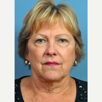 55-64 year old woman treated with Facelift before 3696950
