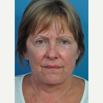 55-64 year old woman treated with Facelift after 3696950