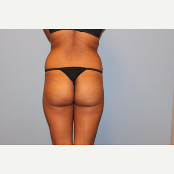 25-34 year old woman treated with Brazilian Butt Lift before 3565707