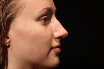 20 Year Old Female Rhinoplasty Surgery before 1088974