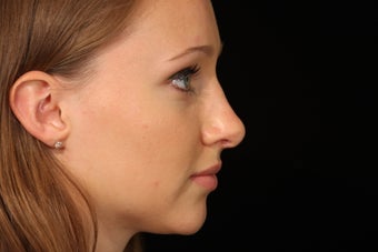 20 Year Old Female Rhinoplasty Surgery after 1088974