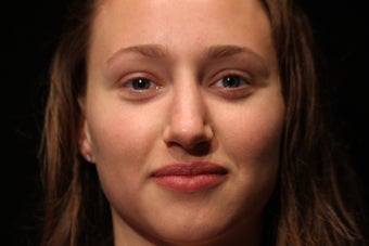 20 Year Old Female Rhinoplasty Surgery 1088974