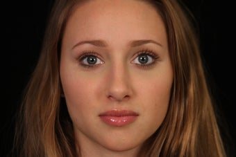 20 Year Old Female Rhinoplasty Surgery 1088974