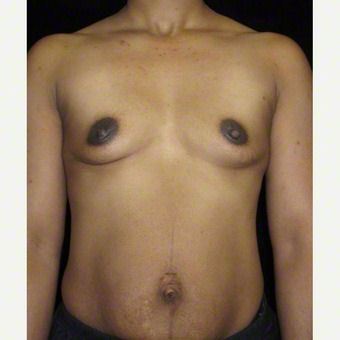 40 year old woman treated with Breast Augmentation before 3103637