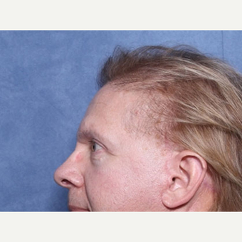 55-64 year old man treated with Ear Surgery (view 2 of 2) after 3180692