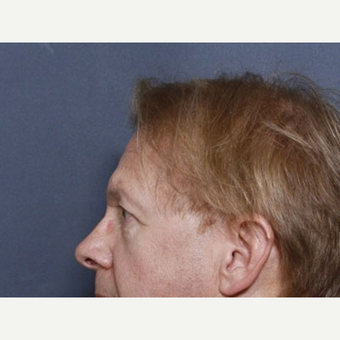 55-64 year old man treated with Ear Surgery (view 2 of 2) before 3180692