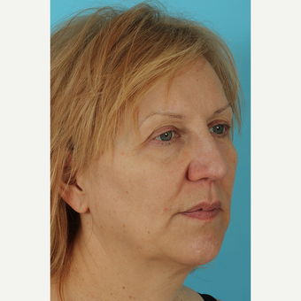 55-64 year old woman treated with Facelift before 3691408