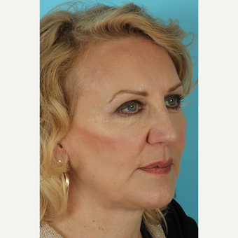 55-64 year old woman treated with Facelift after 3691408