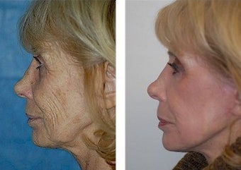 Deep Plane Facelift, CO2 Laser before 308133