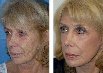 Deep Plane Facelift, CO2 Laser after 308133