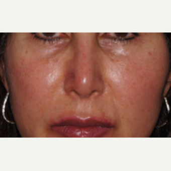 45-54 year old woman treated with Restylane to the nose and lips after 2831069