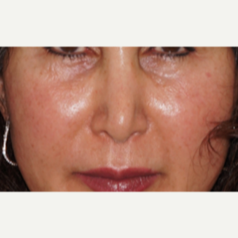 45-54 year old woman treated with Restylane to the nose and lips before 2831069