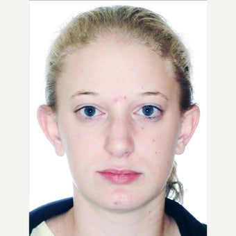 18-24 year old woman treated with Orthognathic Surgery 1539157