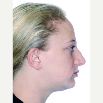 18-24 year old woman treated with Orthognathic Surgery before 1539157