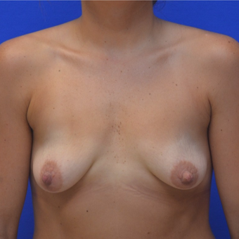 25-34 year old woman treated with Breast Augmentation before 3299292