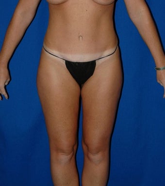 35-44 year old woman treated with SAFELipo after 3126020