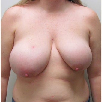 Breast Reduction with Breast Symmetry for this 41 Year Old Woman before 3003213